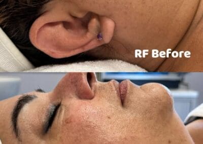 RF before and after