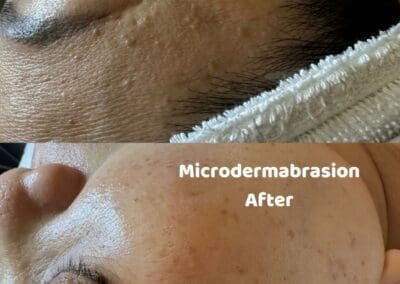 Microdermabrasion before and after