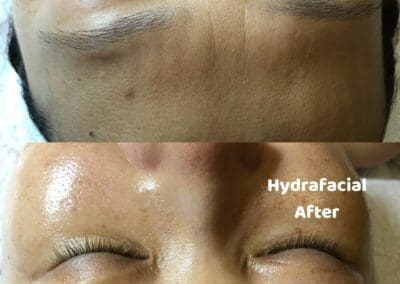 HydraFacial before and after